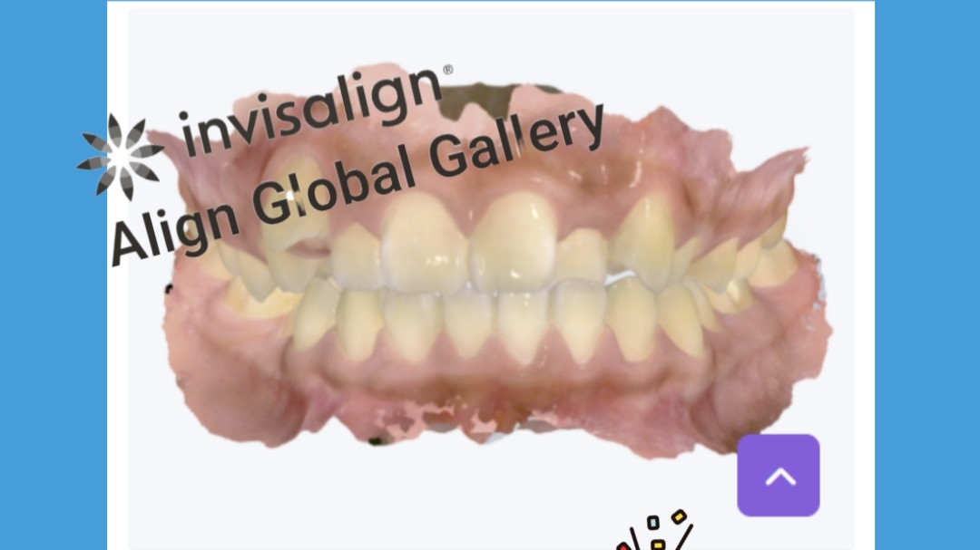 오복어린이치과 인비절라인 글로벌 갤러리 증례 등재!